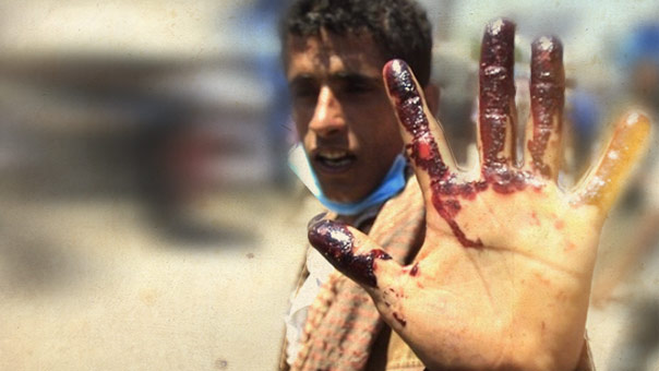 300 يوم على همجية آل سعود في اليمن
