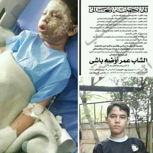 ماذا قال طفل حي ركن الدين الدمشقي لـ&rsquo;العهد&rsquo;؟.. عمر يستعيد وجهه الملائكي الذي أحرقه الإرهابيون